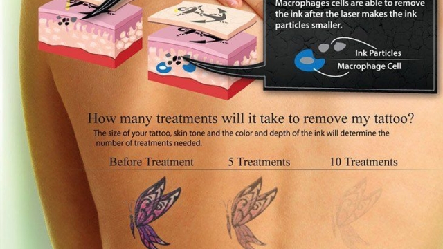 Why Back Tattoo Removal Is Developing