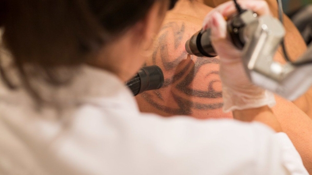 Are Tattoo Removal Creams Safe?