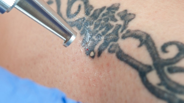 Gang Tattoo Removal – Your Practical Solution With Regard To An Unwanted Tattoo